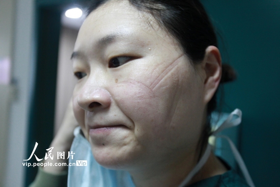 2月14日，揚州市第三人民醫院的一名護士臉上和額頭上被護目鏡和口罩壓出了印痕。